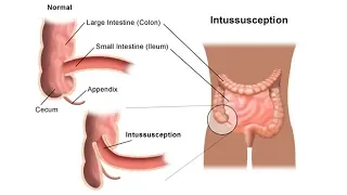 Intussusception in Adults and Children | Tita TV