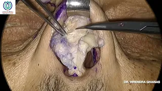 Dr Virendra Ghaisas_Rhinoplasty Cadaveric Dissection Demonstration