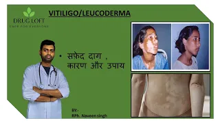 vitiligo/leucoderma skin disease treatment in hindi | types | sign and symptoms |  #information