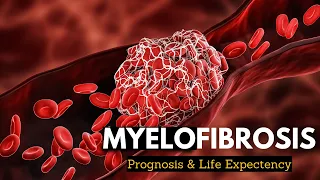 Myelofibrosis Explained: What You Need to Know