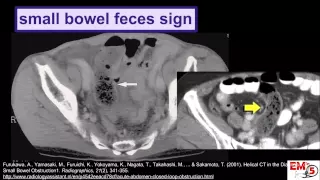 CT Imaging:  Small Bowel Obstruction (SBO)