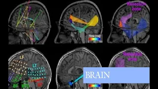 Spike propagation mapping reveals effective connectivity and predicts surgical outcome in epilepsy