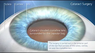 Cataract surgery: All the steps of surgery through high quality video animations