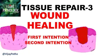 TISSUR REPAIR Part 3: WOUND HEALING, Factors affecting wound healing.