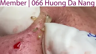 Acne Treatment Huong Da Nang# 066|  Member