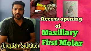Access opening of maxillary first molar