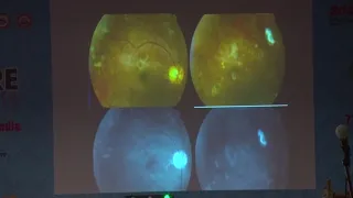 AIOC2019 - IC340 - Practical Pearls in the surgical management of Complex Retinal Detachments