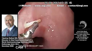 Endoscopy procedure for foreign body removal