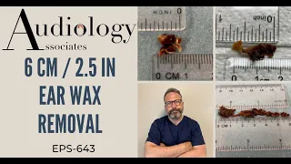 6CM/2.5IN EAR WAX REMOVAL - EP643