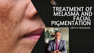 Topical treatment of melasma and facial pigmentation - evidence based review