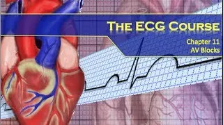 The ECG Course - AV Blocks