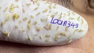 Acne tretment & Blackheads removal (349) | Loan Nguyen