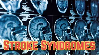 Stroke Syndromes (updated 2023) - CRASH! Medical Review Series