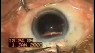 Vid-IC-APAO-simple secondary Inraocular lens Implantation in an Aphakic Patient-1