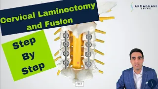 Posterior Cervical Laminectomy and Fusion - Procedure details, recovery, and expectations.