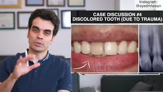 Case Discussion 4  -  Discolored Tooth (due to trauma)