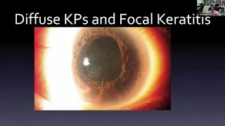 Lecture: Viral Uveitis