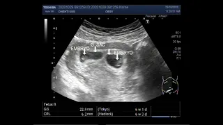 Ultrasound Video showing Early first trimester ( 6 weeks 01 day ) twin Pregnancy.