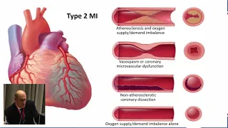 Дж. Альперт “IV определение инфаркта миокарда: спорные вопросы”