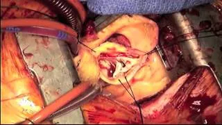 Repair of Bicuspid Aortic Valve and Ascending Aortic Aneurysm Through Ministernotomy Approach