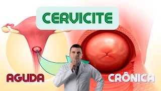 Cervicite Crônica e Aguda