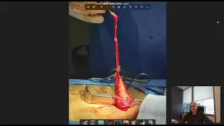 Giant Varicose veins taken out by Istanbul Varicocelectomy Technique