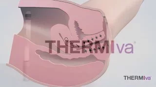 ThermiVa Animation of Non Surgical Labiaplasty and Vaginal Tightening