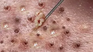 Blackhead Removal With Sac Dep Spa @10007086