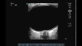 Optic Nerve Ultrasound and Optic Nerve Sheath Diameter (ONSD) measurement