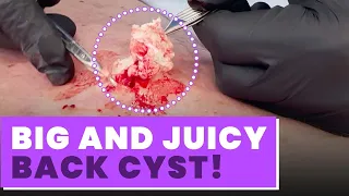 BIG AND JUICY BACK CYST!
