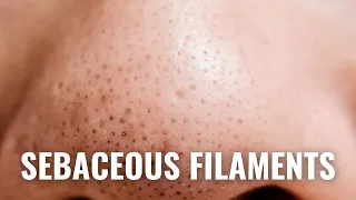 How To Get Rid of Sebaceous Filaments QUICKLY