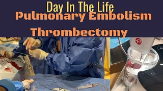 Interventional Radiology - Day in the Life - Episode 2 - PE Thrombectomy