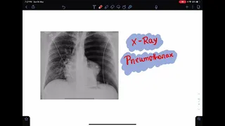 X-Ray of Pneumothorax #xray #pneumothorax #radiology #imaging #xraytutorial #chestxray