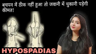 HYPOSPADIAS | बचपन में ठीक नहीं हुआ तो जवानी में चुकानी पड़ेगी कीमत |