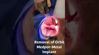 Removing Orbital Metal Implant from prior orbital fracture repair.