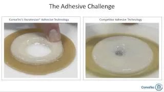 ConvaTec Moldable Technology™ in Action - Durahesive