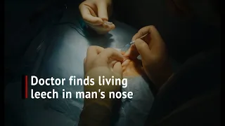 Vietnamese doctor removes giant living leech from man's nose