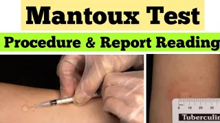 Mantoux Test in Hindi  | Tuberculin Skin Test | mantoux test results reading