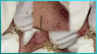 Big Cystic Acne Blackheads Extraction Blackheads & Milia, Whiteheads Removal Pimple Popping