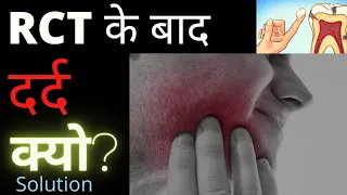 RCT ke Baad bhi Dard kyu hota he? | Pain after Root Canal Treatment | RCT Failure| RE-RCT |Dental ji