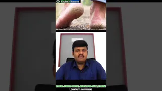 cracks on feet tamil | cracks on heels |  பாத வெடிப்பு | Dr Balajimuthu
