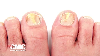 What is toenail fungus?