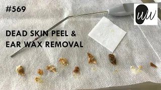 569 - Dead Skin Peel & Ear Wax Removal
