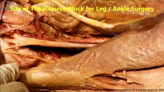 SCIATIC in Gluteal Thigh TIBIAL FIBULAR NERVE in Leg Ankle PLANTAR N in Foot–Sanjoy Sanyal – Proceum