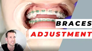 Orthodontist Explains Monthly Adjustments | Monthly Visits