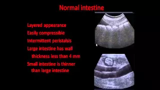 3-role of intestinal ultrasound in imaging of bowel disease intestinal ultrasound Dr AHMED ESAWY