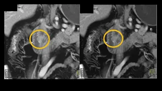 MDCT of the Small Bowel Tumors: Detection and Classification Part 1