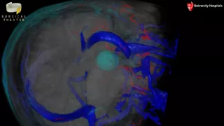 Right Cerebellopontine Angle Meningioma