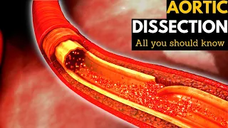 Aortic Dissection, Causes, Signs and Symptoms, Diagnosis and Treatment