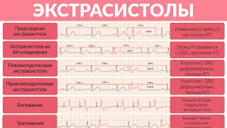 ЭКГ Разбор Экстрасистолы